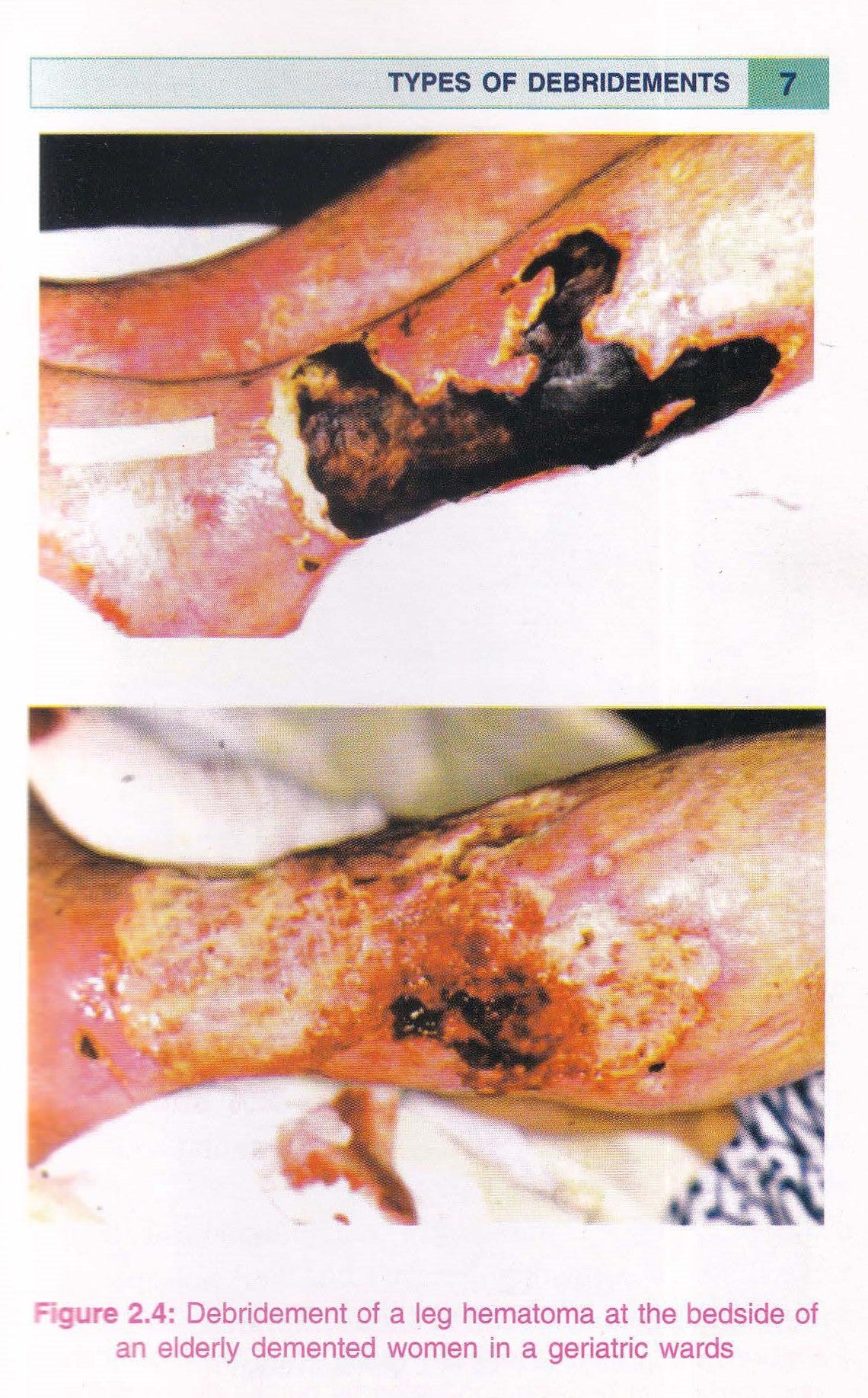 Step By Step Wound Healing With Cd-rom